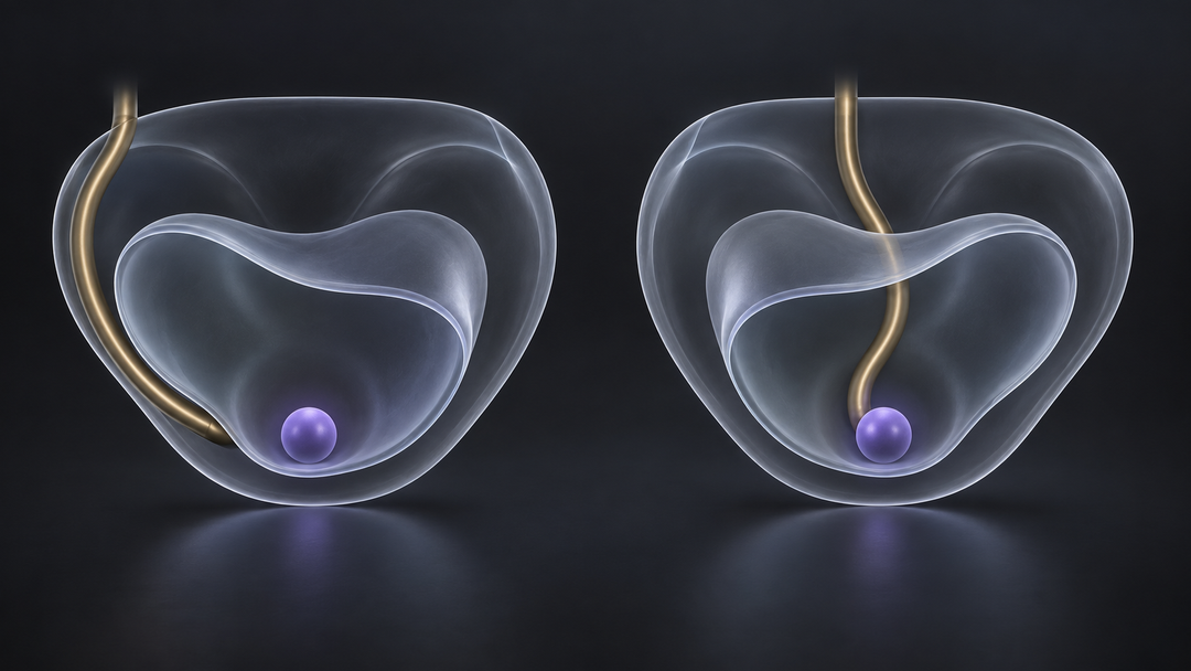 Original medical illustration for: Comparing Surgical Routes for Robotic Prostate Cancer Surgery: Extraperitoneal vs. Transperitoneal Single-Port Approaches