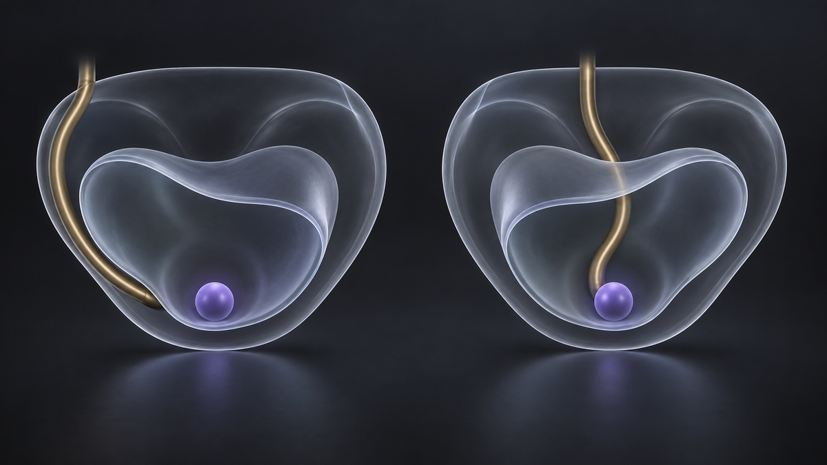 Original medical illustration for: Comparing Surgical Routes for Robotic Prostate Cancer Surgery: Extraperitoneal vs. Transperitoneal Single-Port Approaches